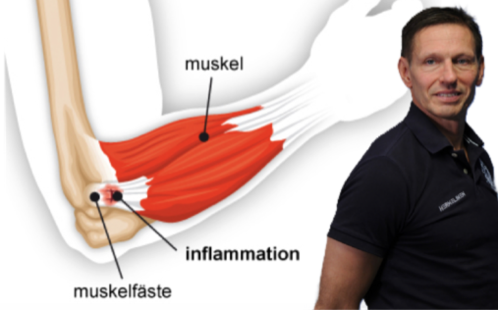 Varför drabbas så många av padelarmbågen?